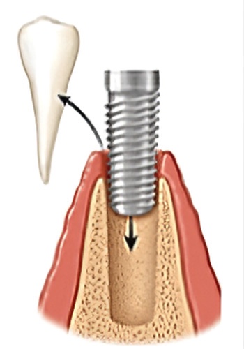 Implants dentaires Strasbourg 5